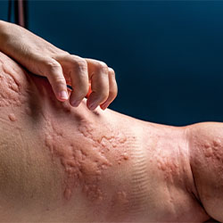 Allergie Hautreaktion Allergie Hautreaktion