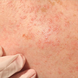 Allergie Reaktion Haut Allergie Reaktion Haut